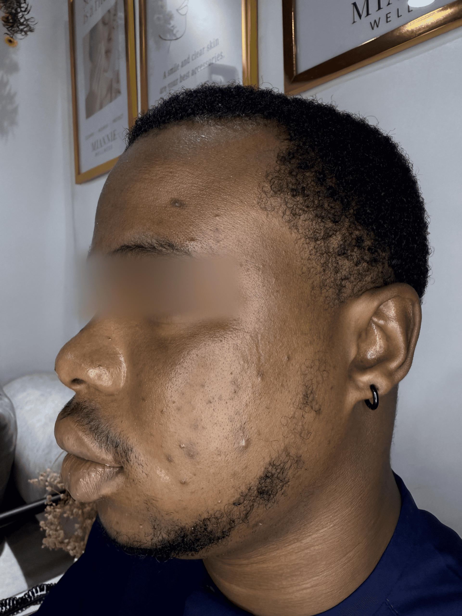 Before Treatment