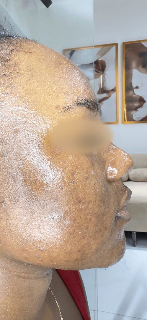 After Acne Transformation