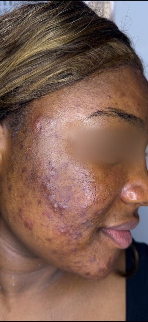 Before Acne Transformation