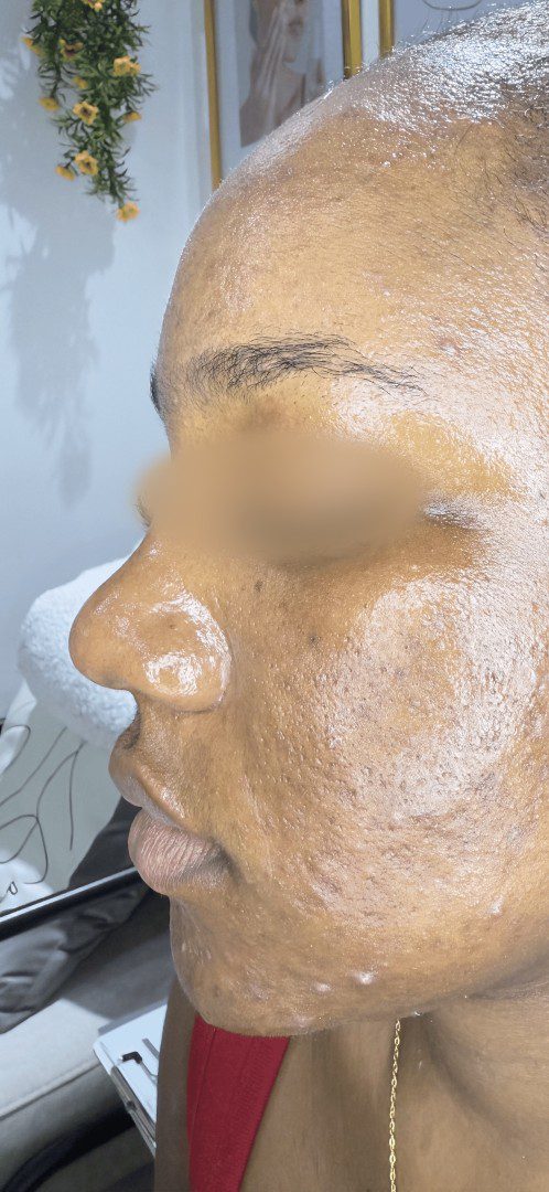 After Acne Correction