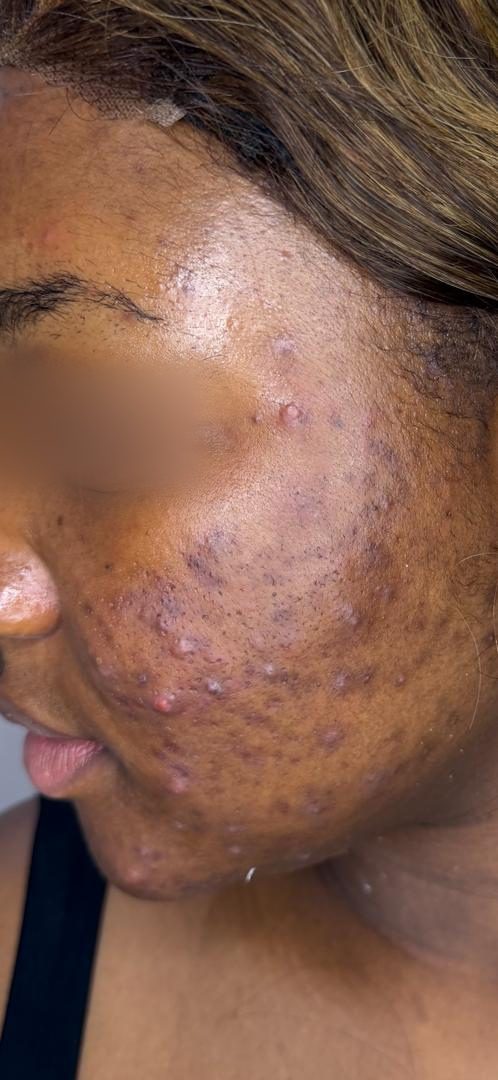 Before Acne Correction