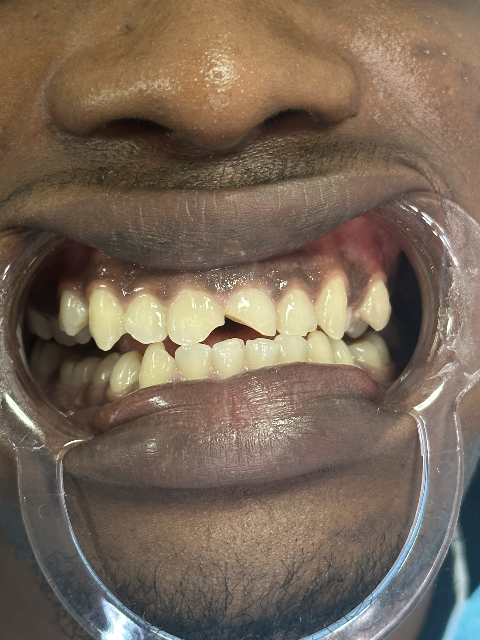 Before Composite Bonding