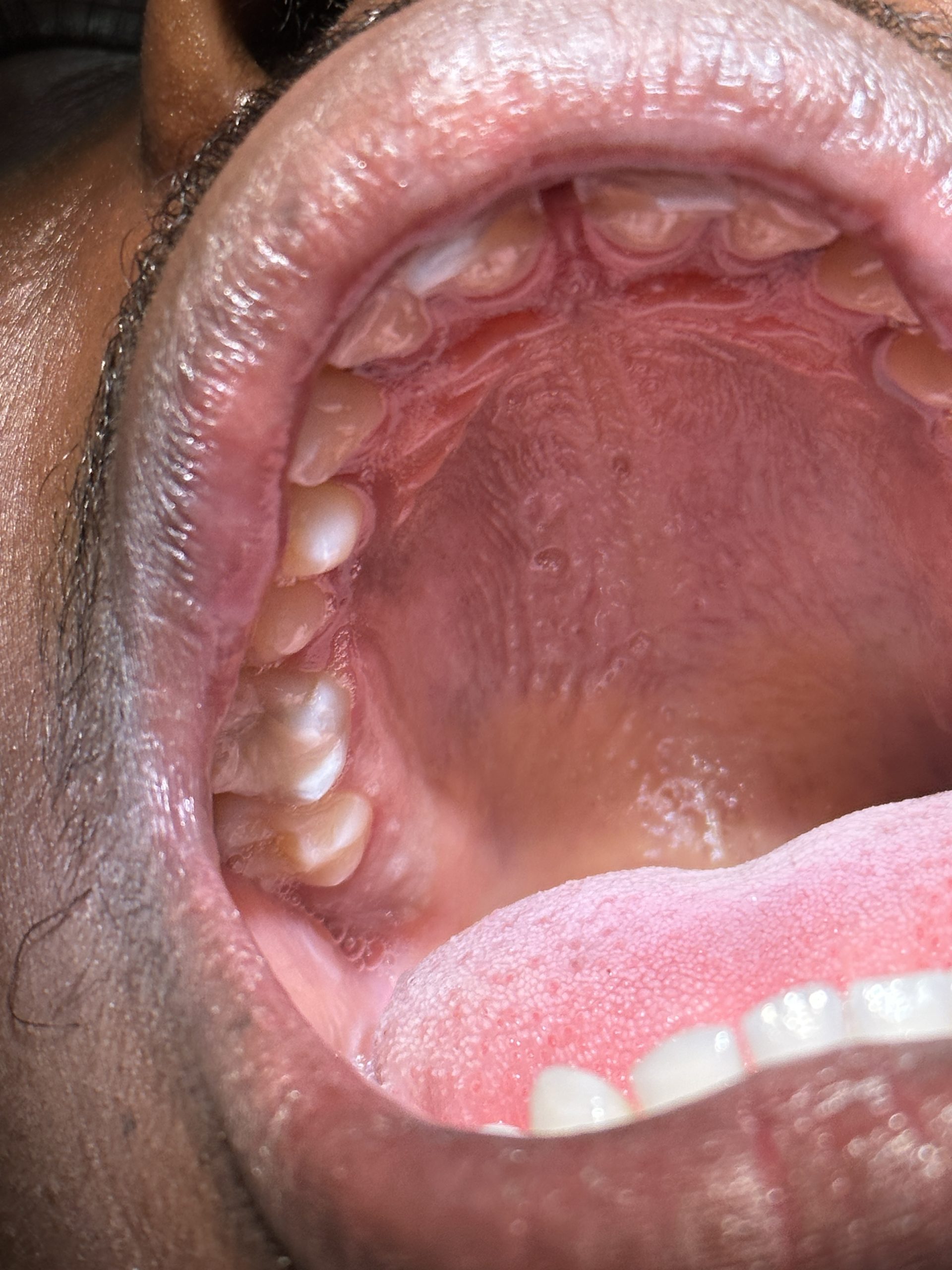 After Dental Filling