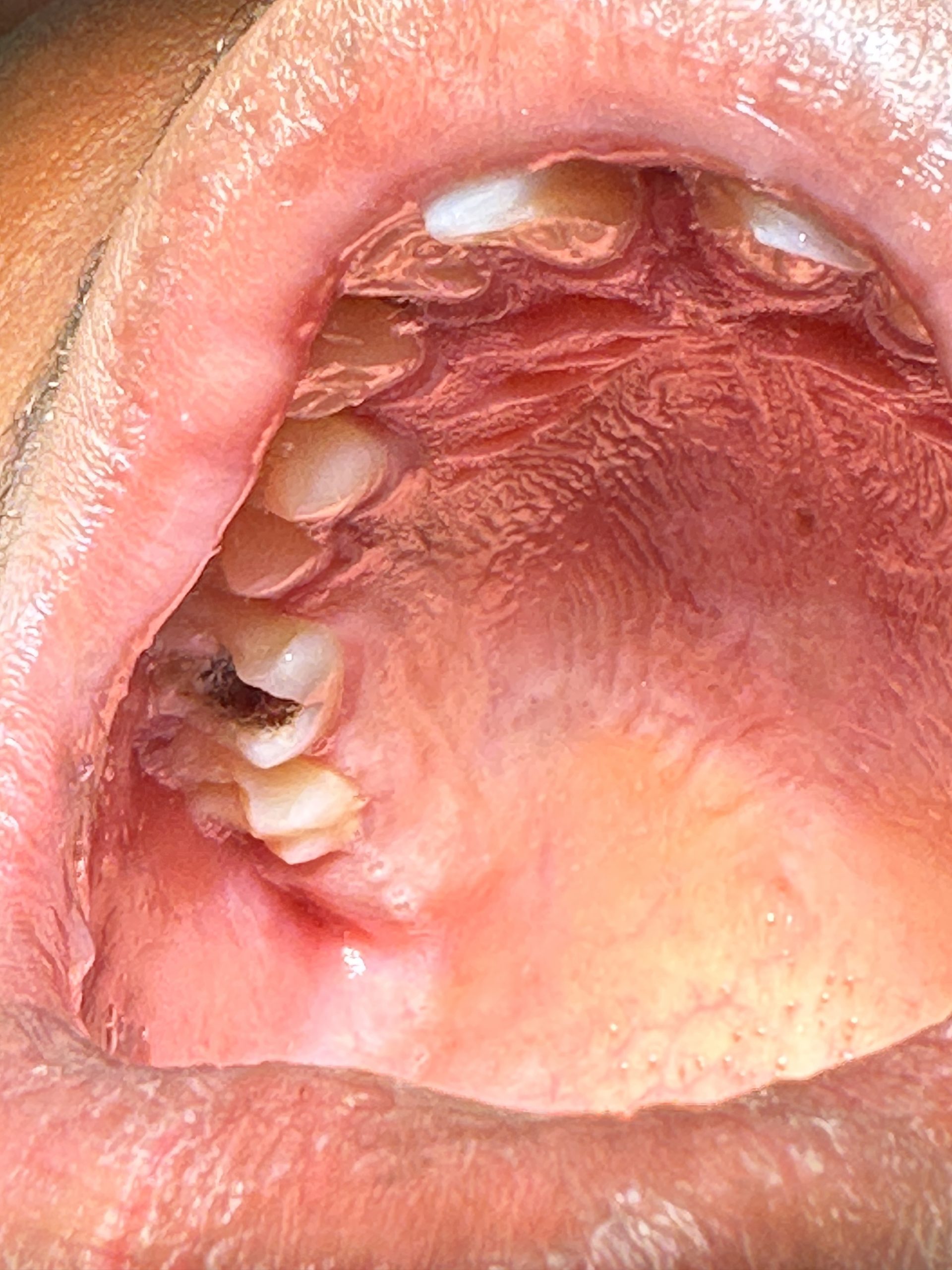 Before Dental Filling