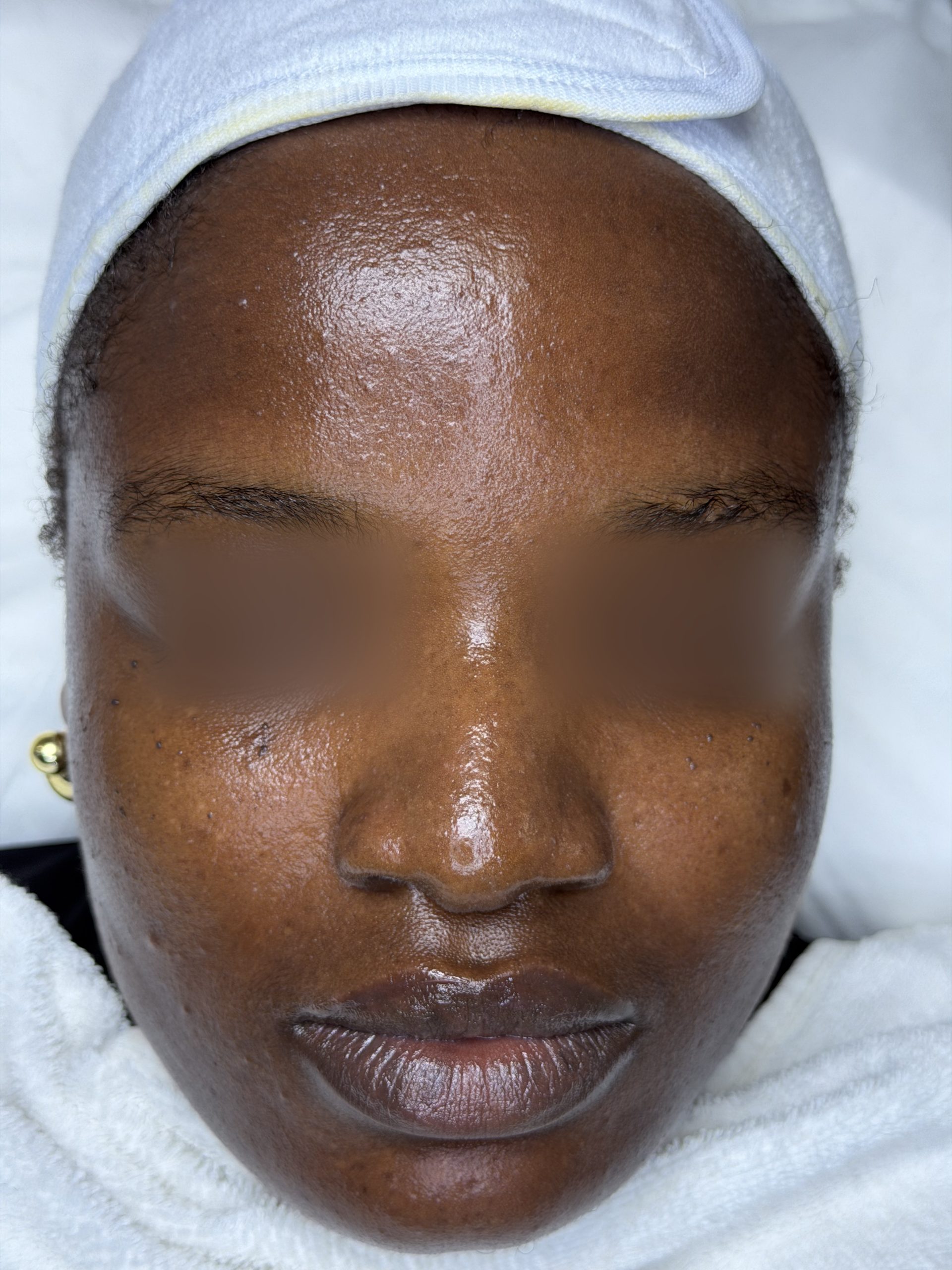 After Enzymatic Facial