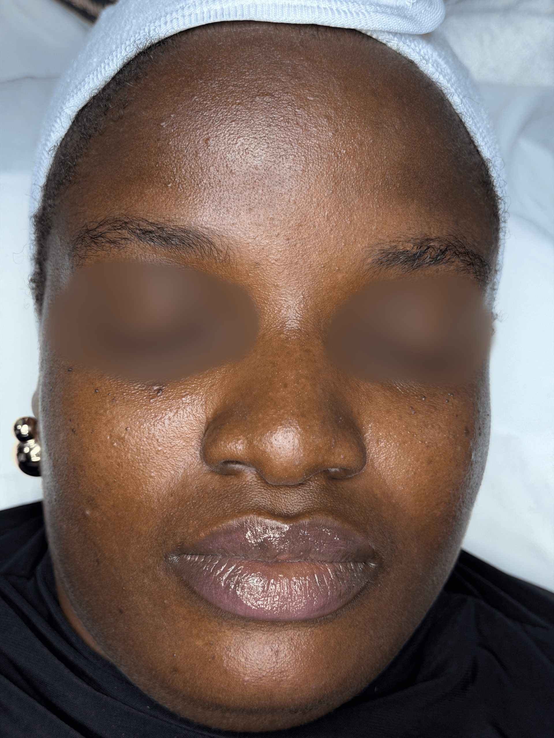 Before Enzymatic Facial