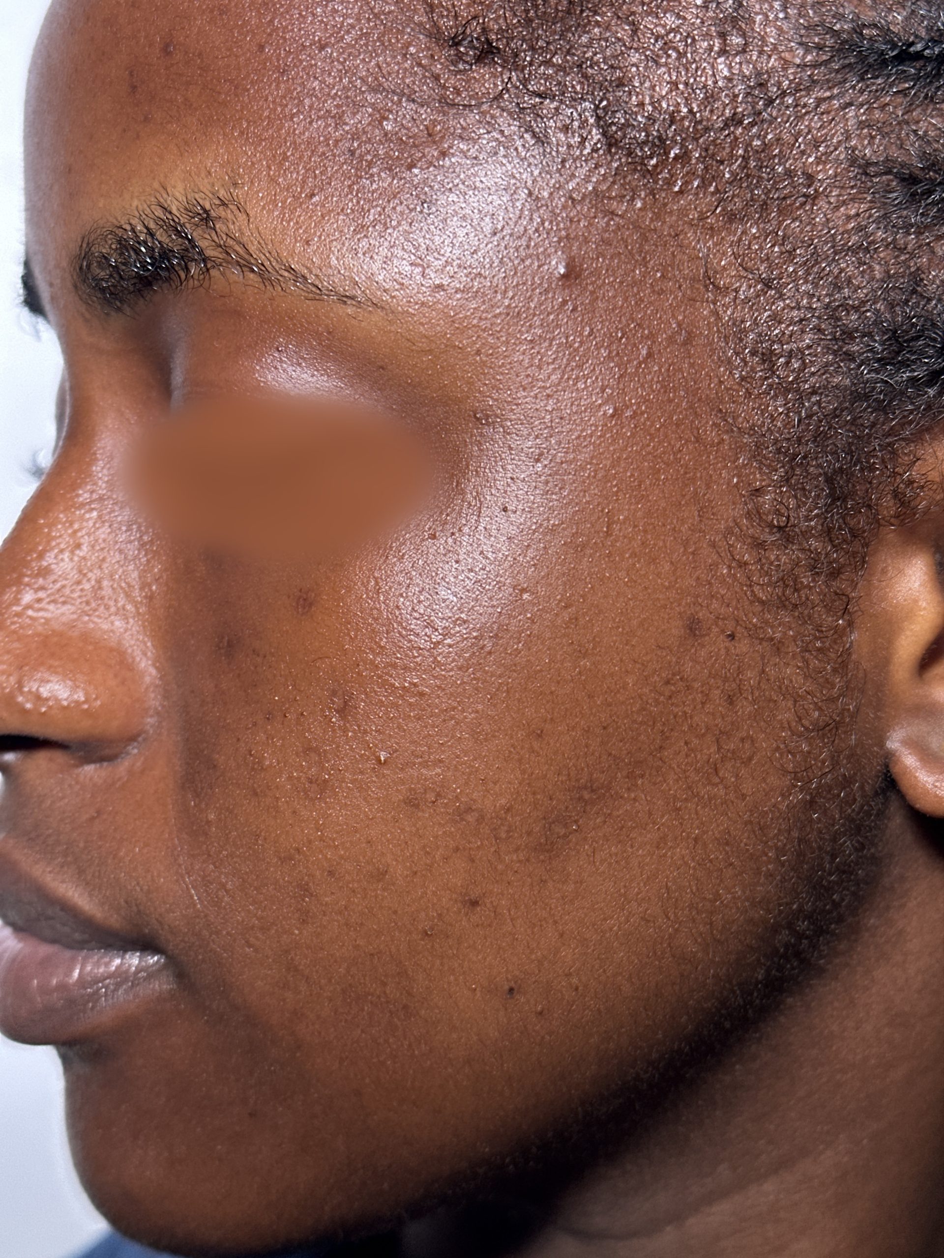 After Mole Removal