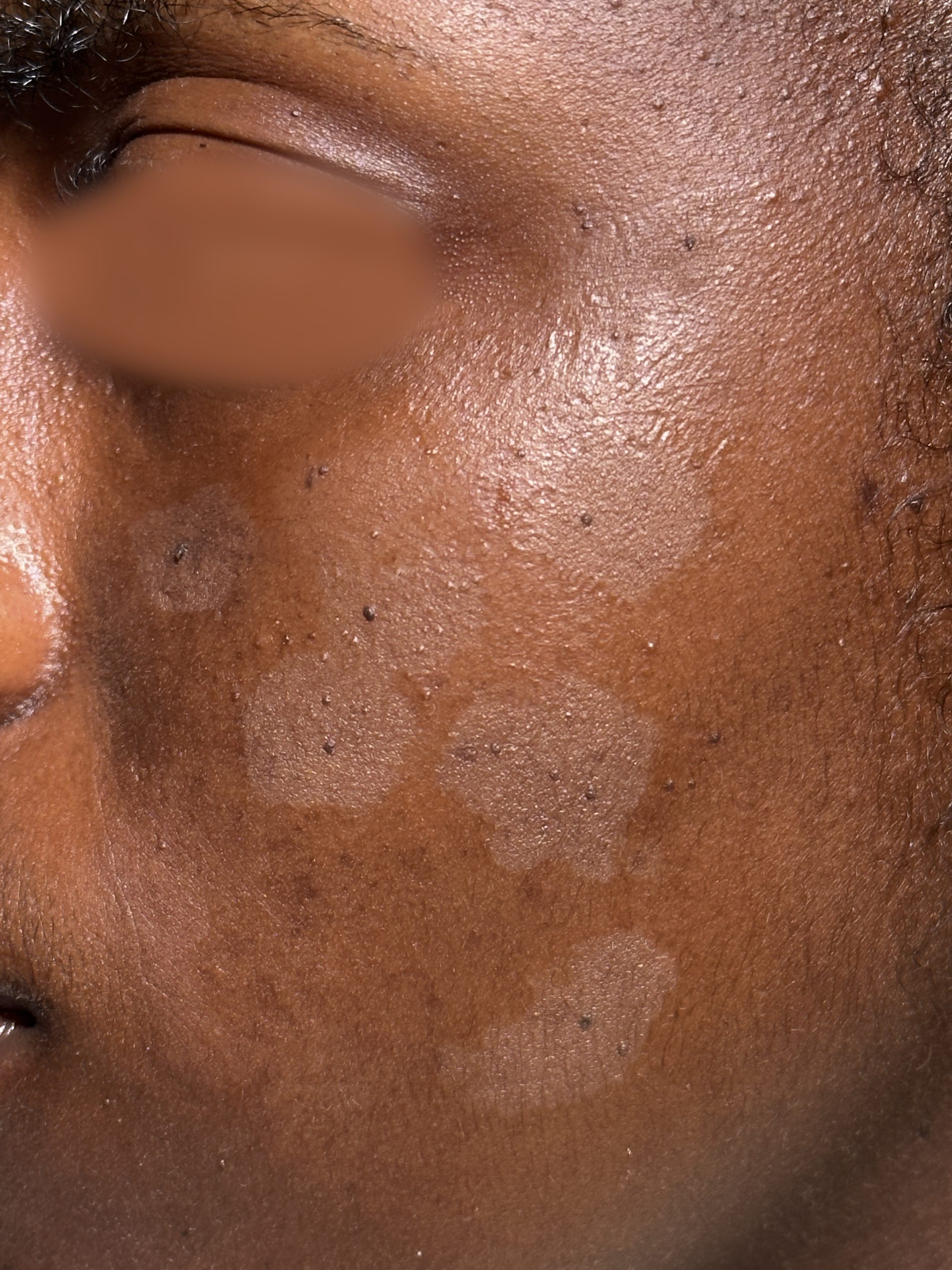Before Mole Removal