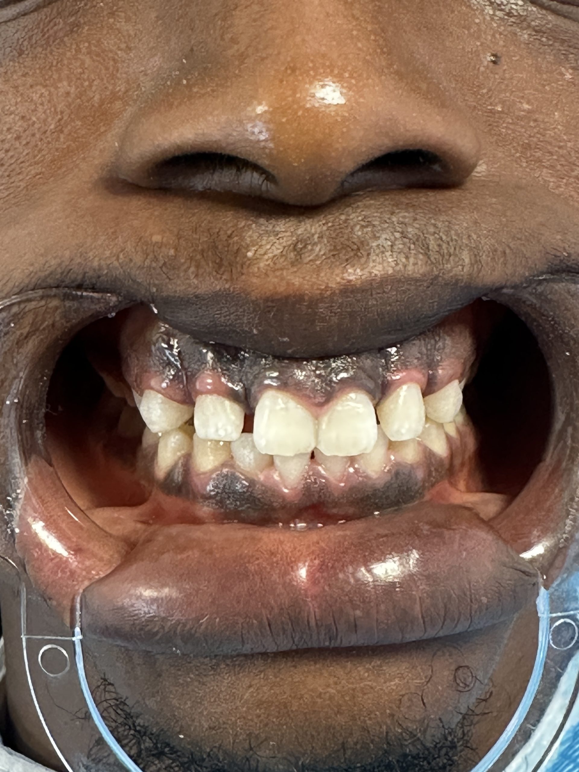 After Teeth Whitening