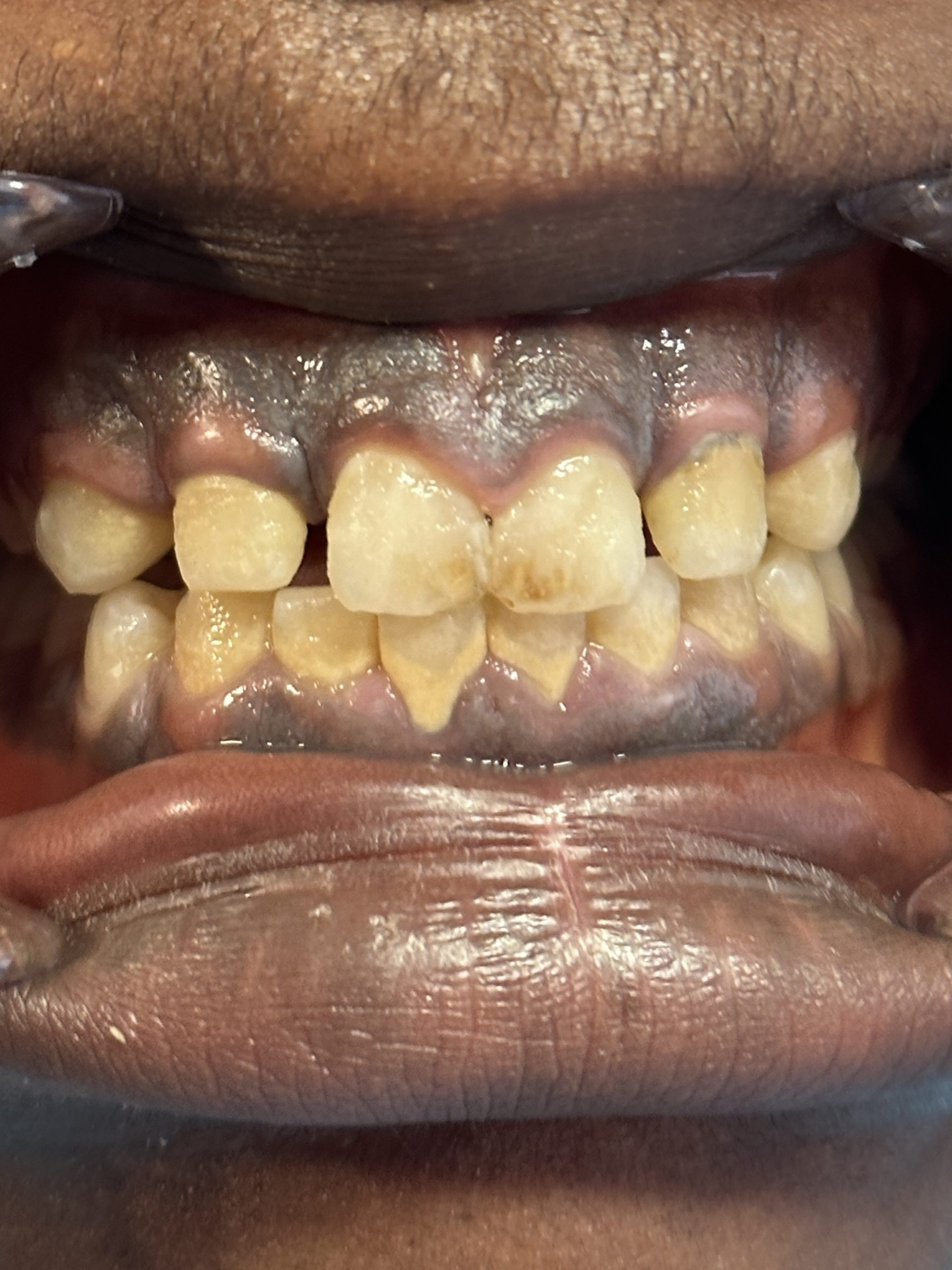 Before Teeth Whitening