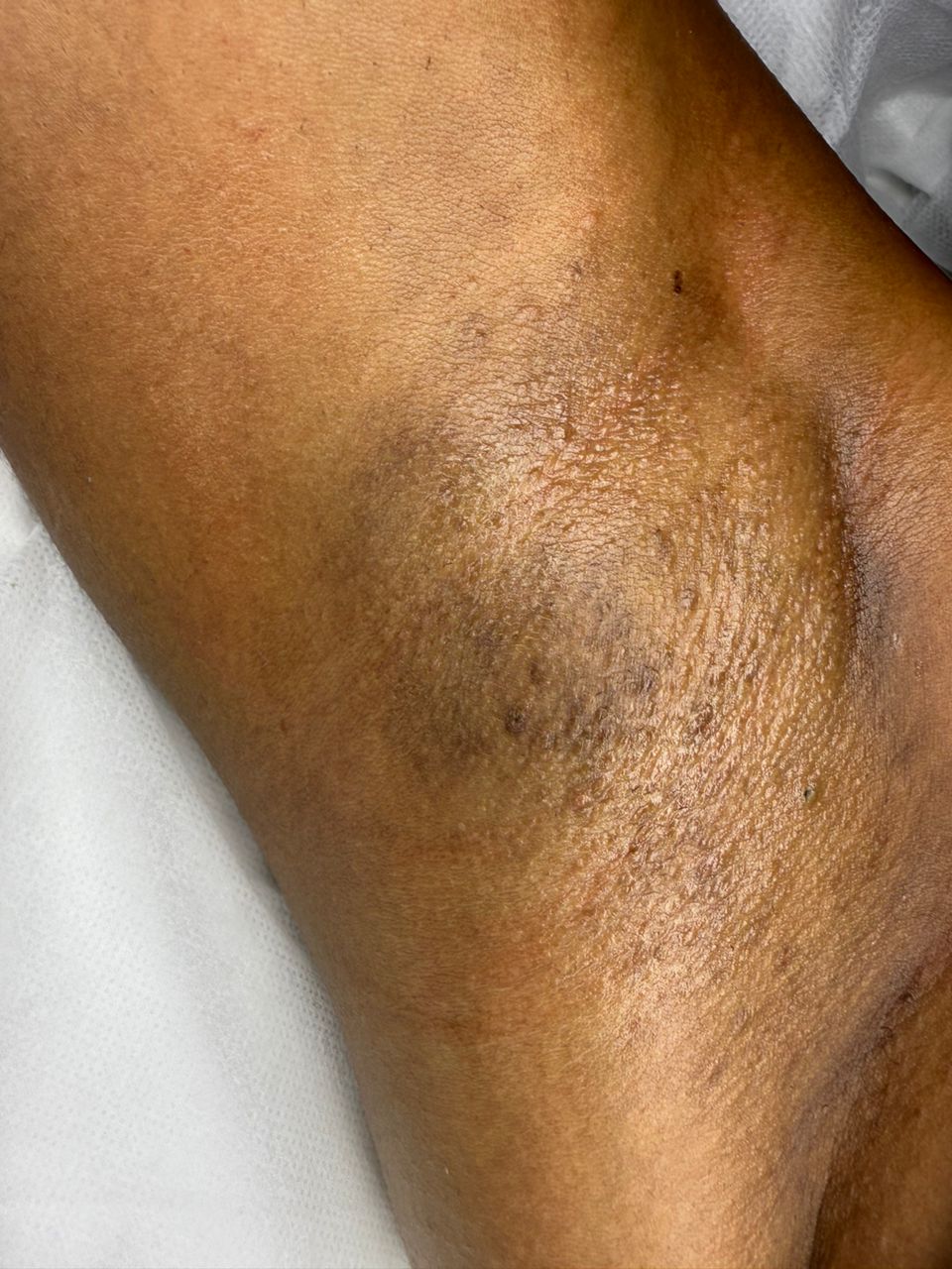 After Underarm Waxing