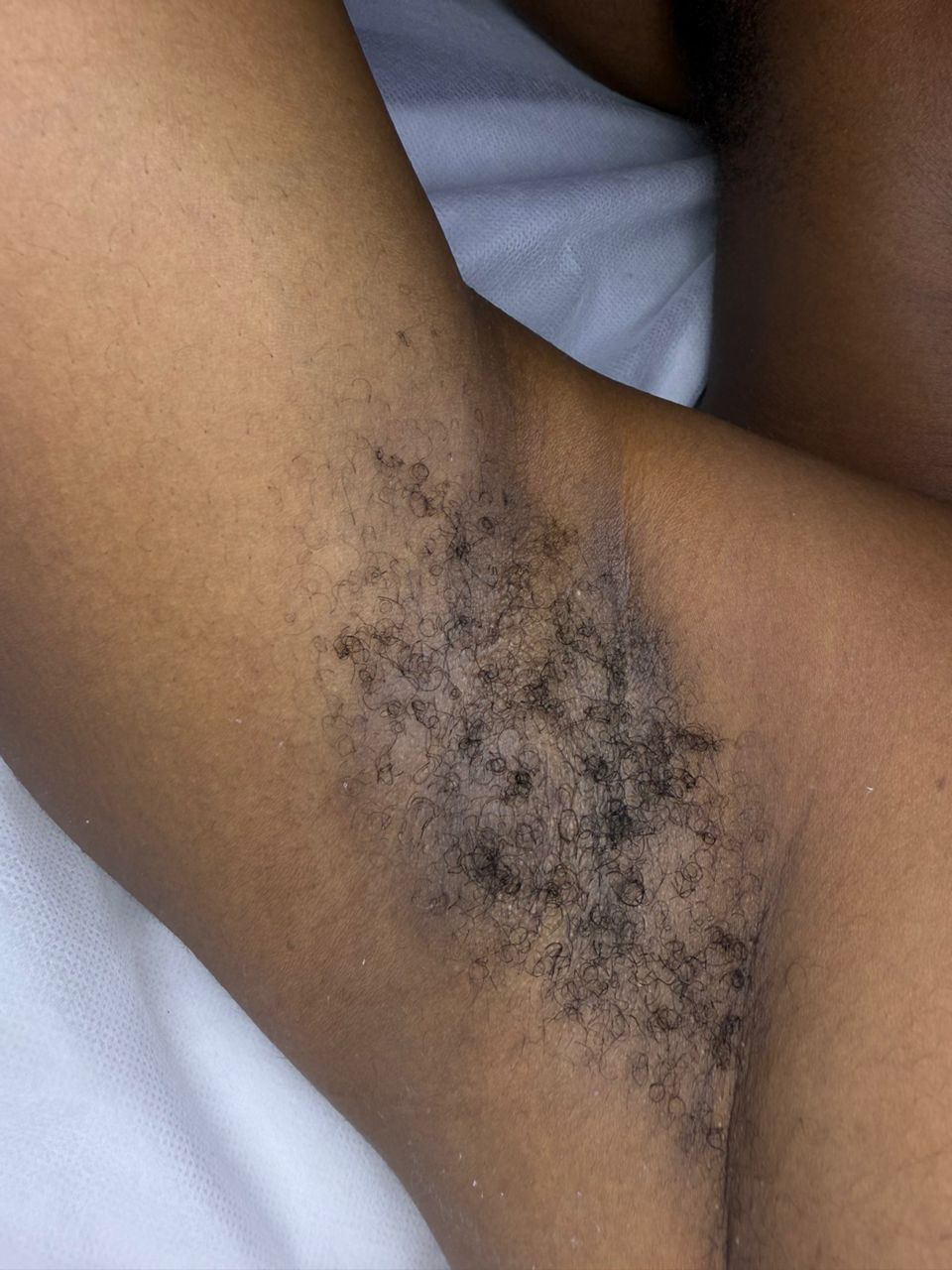 Before Underarm Waxing