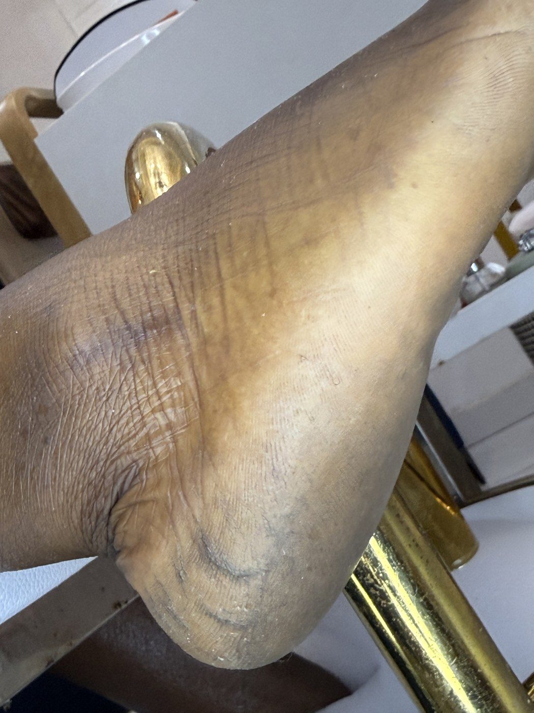 Before Miannie Special Pedicure Cracked Heel Restoration
